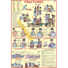 Fractures-vcp