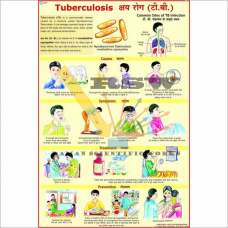 Tuberculosis-vcp